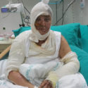 Samsun'da Azeri uyruklu bir kadın, kendisine tecavüz etmek isteyen kişi tarafından kezzapla yakıldı.