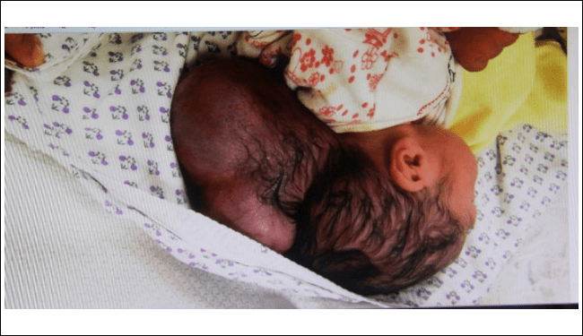 Hatay'da dünyada 5 bin doğumda bir görülen 'cranium bifidum' teşhisiyle ikiz kafalı bebek.